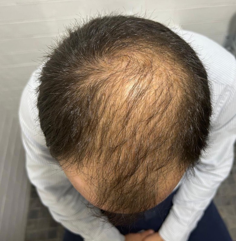 caso implante capilar-2-antes