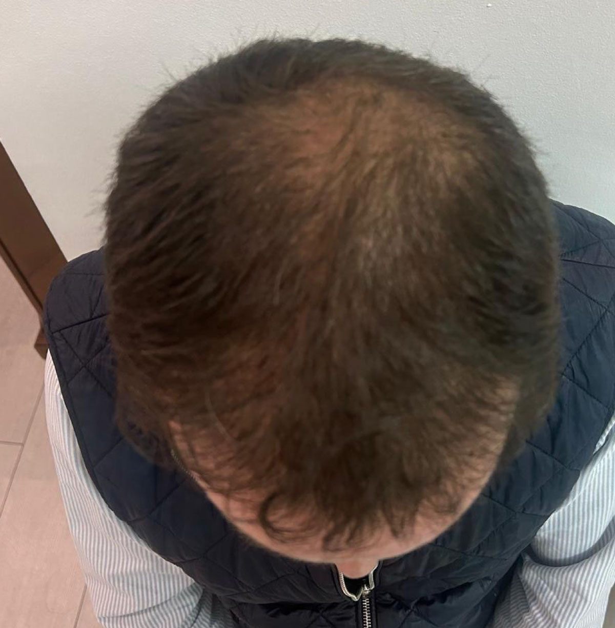 caso implante capilar-2-despues