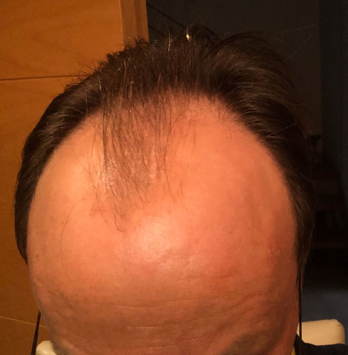 caso implante capilar-3-antes