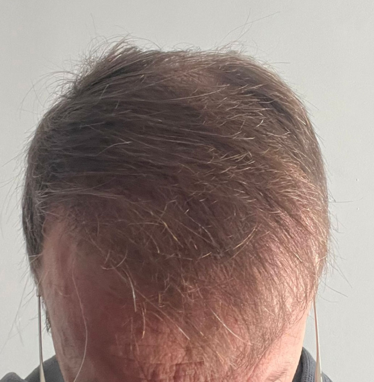 caso implante capilar-3-despues