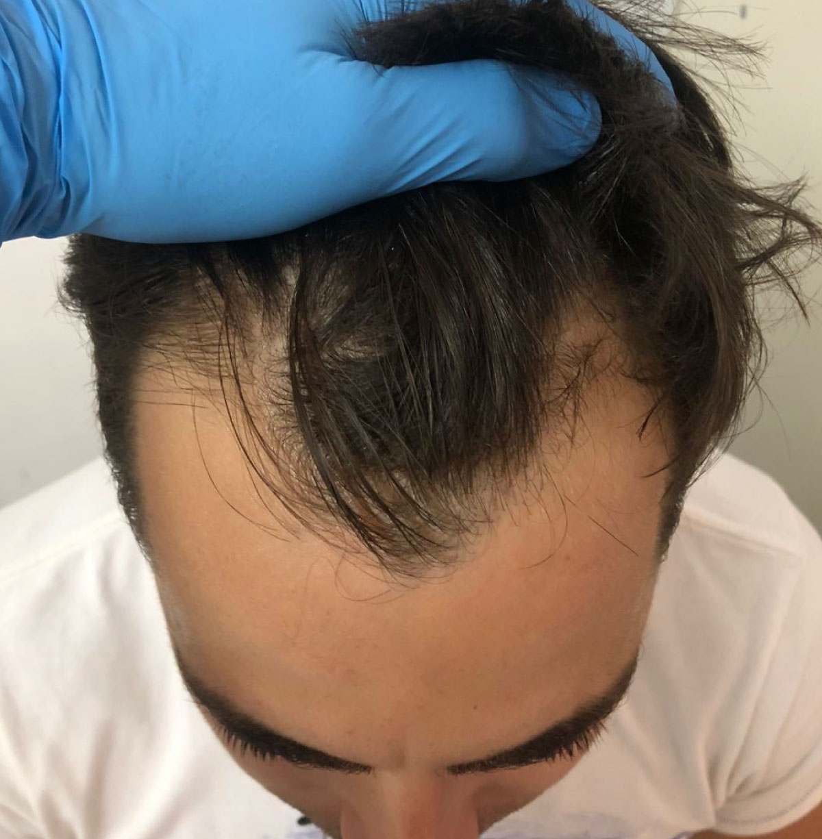 antes del implante capilar en CVIC