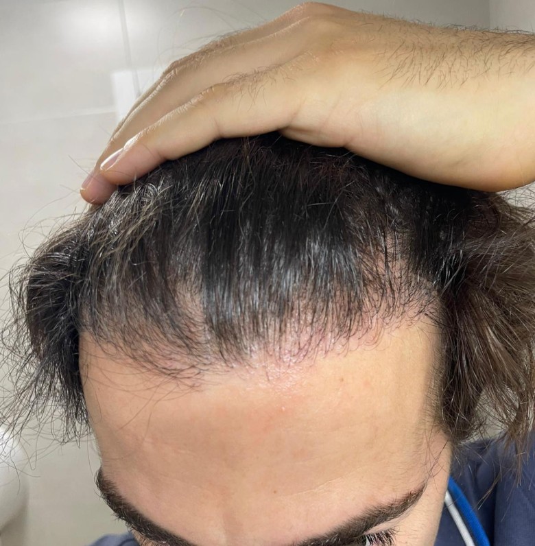 implante capilar resultado